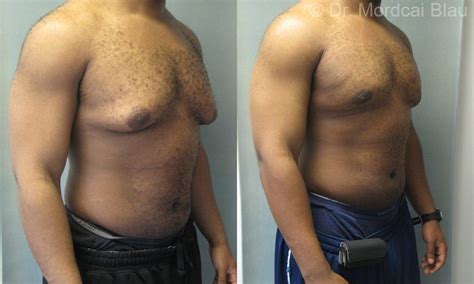 gynecomastia melbourne fl|Gynecomastia Before and After Photos Case 29 .